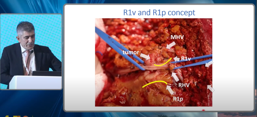 Surgery in colorectal liver metastasis